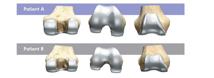 femoral fit